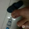 甲沟炎治疗后怎样预防复发呢