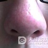 患上酒渣鼻后日常护理该怎么做？