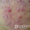化妆品容易引起痤疮吗