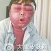 成人硬肿症有什么的临床特点