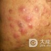 青春痘留下的痘坑怎么办