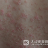 牛皮癣很难治愈吗