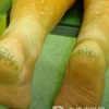 手足皲裂预防的主要方法是什么
