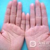 怎么用香蕉治疗手足皲裂
