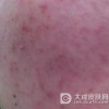 中医治疗日光性皮炎呢