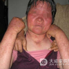 日光性皮炎治疗用什么药