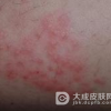季节性皮肤过敏怎么预防