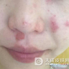 皮肤过敏要注意的事项有哪些