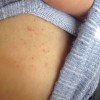 过敏性紫癜患者如何正确选用护肤品