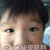 单纯糠疹要怎么预防