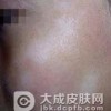 单纯糠疹的预防方法是什么