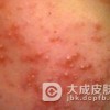 怎么判断脸上长的青春痘
