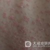 治疗过程中牛皮癣患者要注意哪些