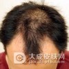 脱发治疗常见的误区有哪些呢
