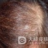 斑秃与脂溢性脱发的区别有哪些