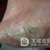 得了手足癣会不会传染给别人