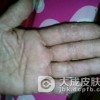 手足癣潜在的隐患是什么呢