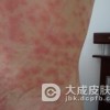 究竟荨麻疹都会带来哪些危害呢