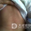 丘疹性荨麻疹传染吗