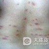 丘疹性荨麻疹到底会不会传染呢