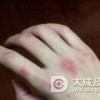 为什么穿长靴更容易长冻疮呢