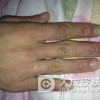 冻疮该怎样预防呢