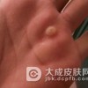 得了寻常疣要注意哪些问题