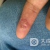 寻常疣不治疗会变多吗