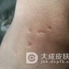寻常疣要怎么预防