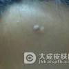 寻常疣的预防与护理应注意哪些方面