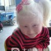 白化病患者的眼睛是什么样子的呢