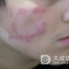 红斑狼疮是什么原因导致的