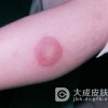 红斑狼疮的病因都会有哪些？
