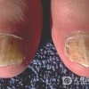 怎样才能做到有效地预防甲沟炎？