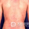 异位性皮炎的病因与预防