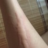 如何确诊日光性荨麻疹