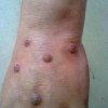 慢性单纯性痒疹的症状体症是什么？