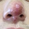 酒渣鼻早期症状是什么