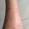 传染性红斑的症状有哪些特点？