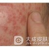 传染性红斑的治疗措施有哪些