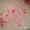 过敏性紫癜应该做哪些检查？