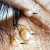 详述传染性软疣的传染途径