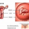 该怎样护理外阴白斑患者的身体？