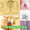 外阴白斑是由什么原因引起