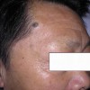 激光去痣后还会再长吗-