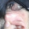 激光去痣适合哪些有痣的人？
