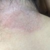 体癣应该如何护理呢