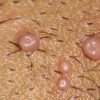 传染性软疣如何预防保健
