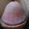 女性患有梅毒有哪些症状
