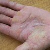 足癣的鉴别诊断有哪些
